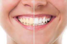 Top-most reasons for teeth whitening in Hervey Bay